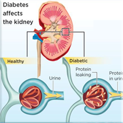 Diabetic Kidney Disorder